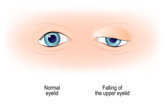 眼瞼下垂の画像